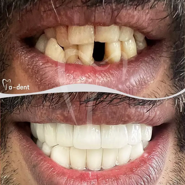 Slider image (7) A-Dent Dental Clinic in Antalya, Turkey